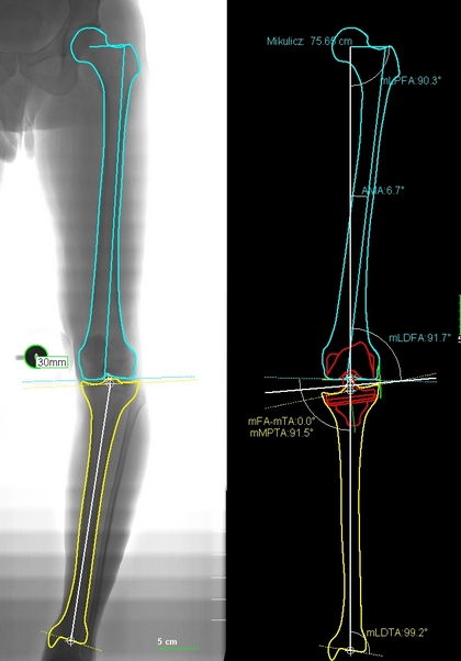 Preoperative planning on a full leg xray